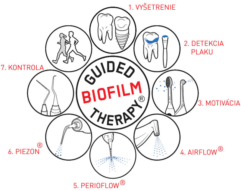 Postup ošetrenia Guided Biofilm Therapy – 7 krokov dentálnej hygieny
